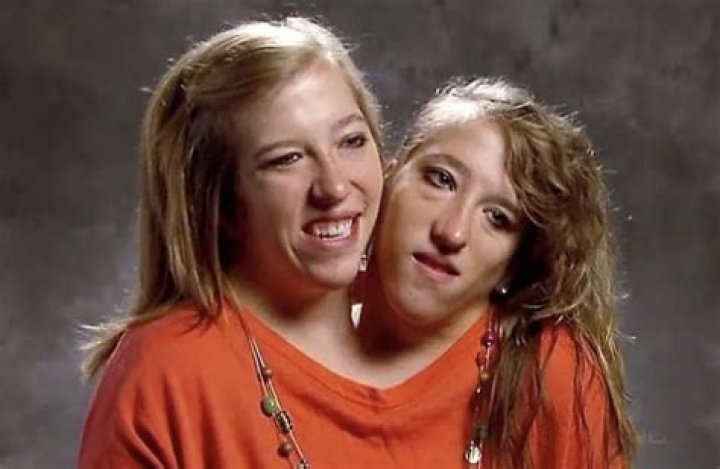 Amber and Brittany Conjoined Twins: The Extraordinary Journey of Resilience and Hope