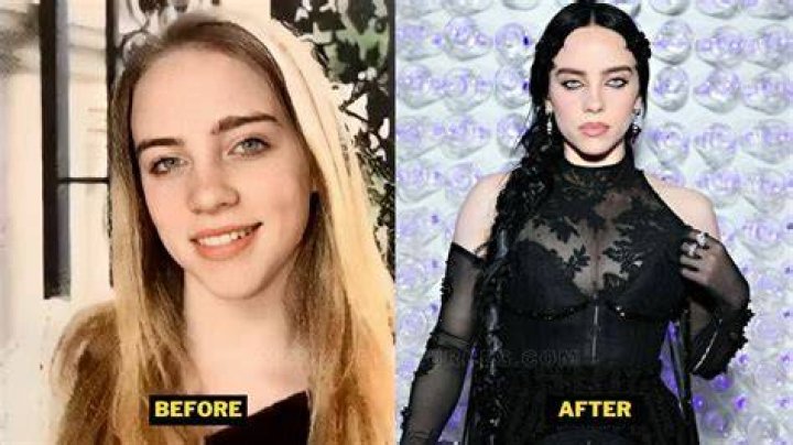 Billie Eilish Breast Surgery: Unveiling Facts, Myths, and Her Journey