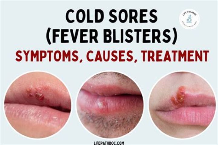 Can I Pop a Fever Blister? Everything You Need to Know