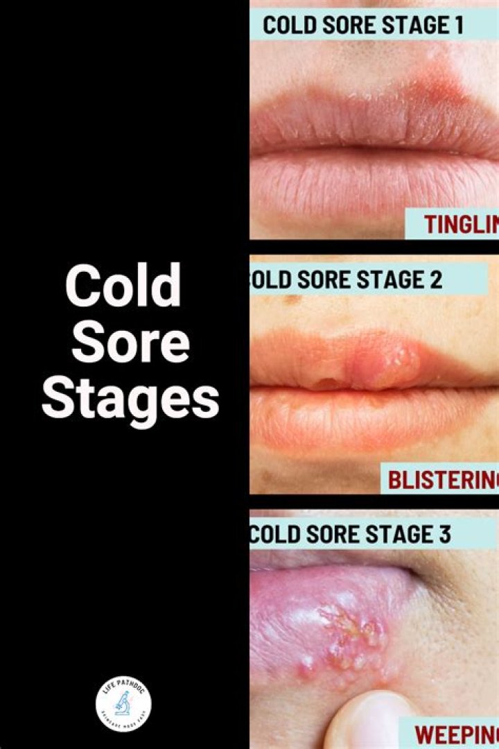 Can You Burst a Cold Sore? Understanding the Risks, Causes, and Effective Treatments