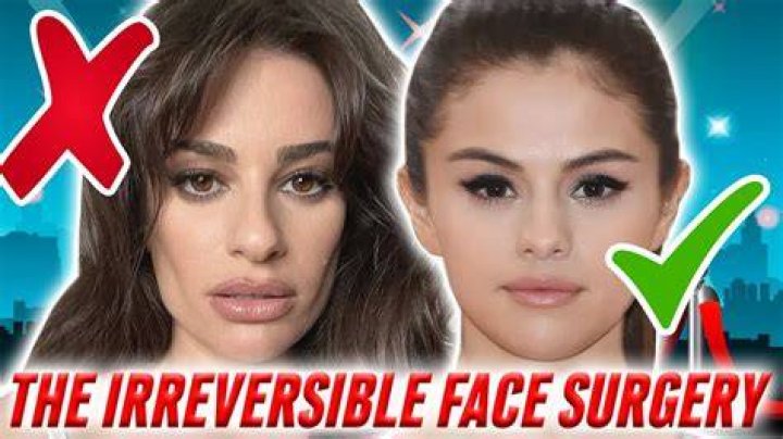 Celebrity Buccal Fat: The Ultimate Guide to Understanding the Trend