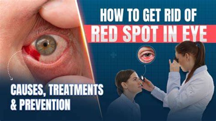 Comprehensive Guide to Redpot Under Eye: Causes, Treatments, and Prevention