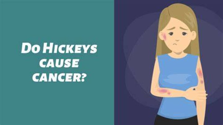 Do Hickeys Cause Cancer? Exploring the Myths and Facts