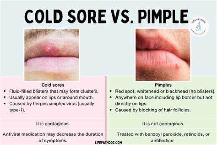 Does a Cold Sore Pop Like a Pimple? Everything You Need to Know