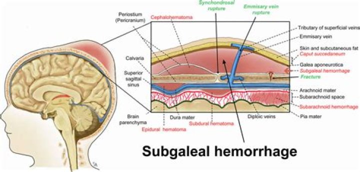 Galeal Hemorrhage: Understanding Causes, Symptoms, Diagnosis, and Treatment