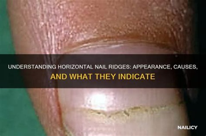 Horizontal Ridges on Your Nails: Causes, Treatments, and What They Indicate