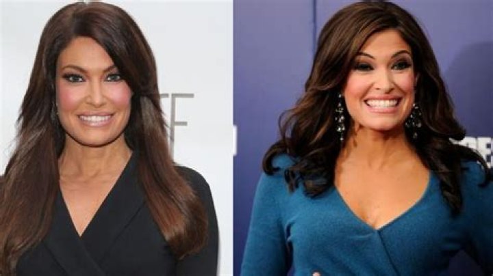Kimberly Guilfoyle Plastic Surgery Face: Unveiling the Truth and Expert Insights