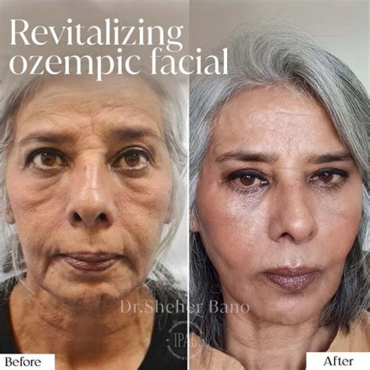 Ozempic Face Before and After: Unveiling the Transformation