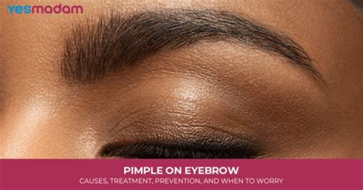 Pimple in Eyebrows: Causes, Treatments, and Prevention Tips