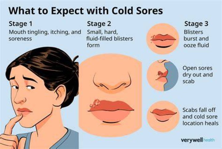 Should You Pop Cold Sores on Lips: A Comprehensive Guide to Understanding and Treating Cold Sores
