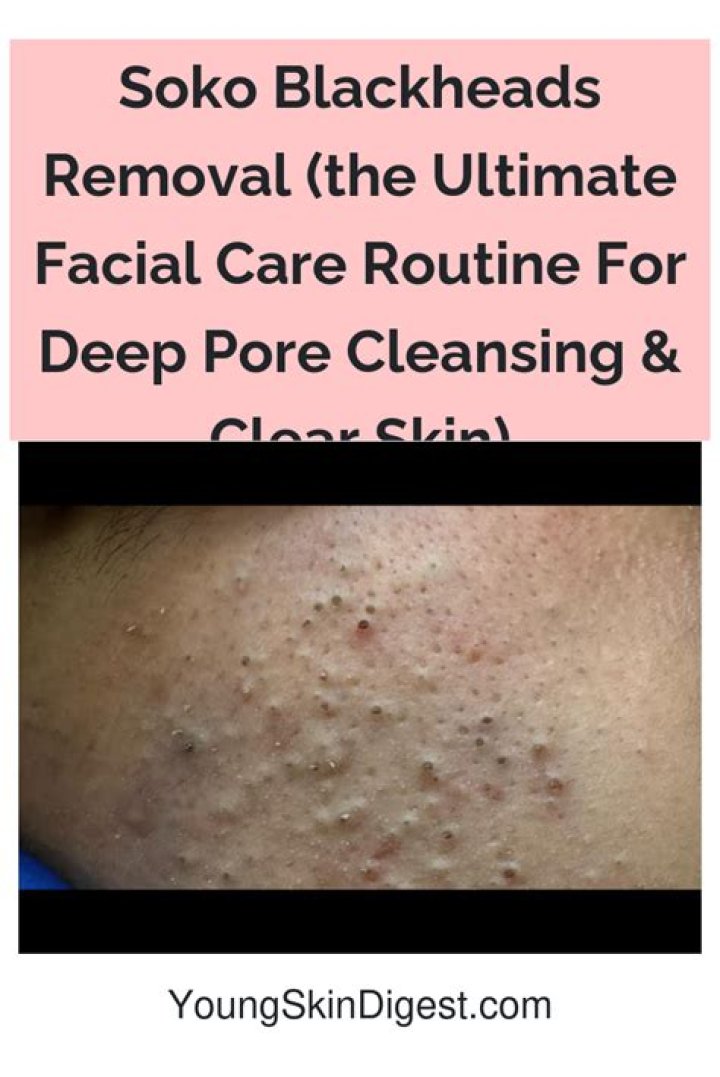 Skin Care Regimen for Blackheads: Your Ultimate Guide to Clear and Radiant Skin